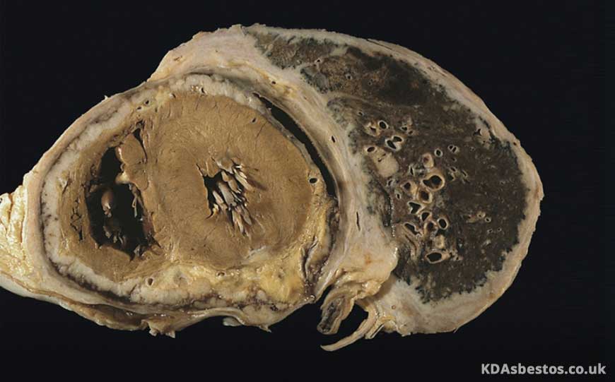 mezoteliom Pleural difuz