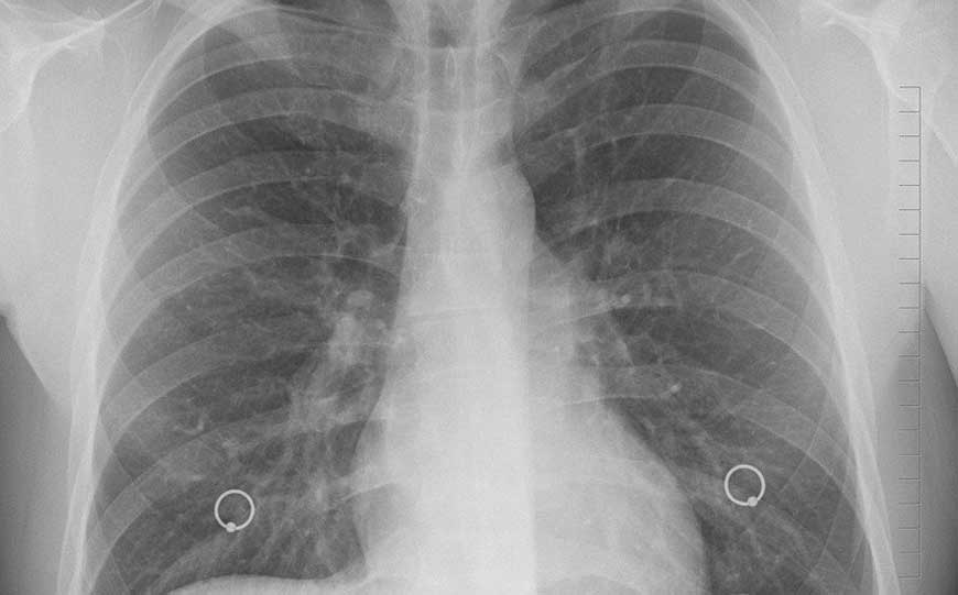 mesothelioma scrotal pathology