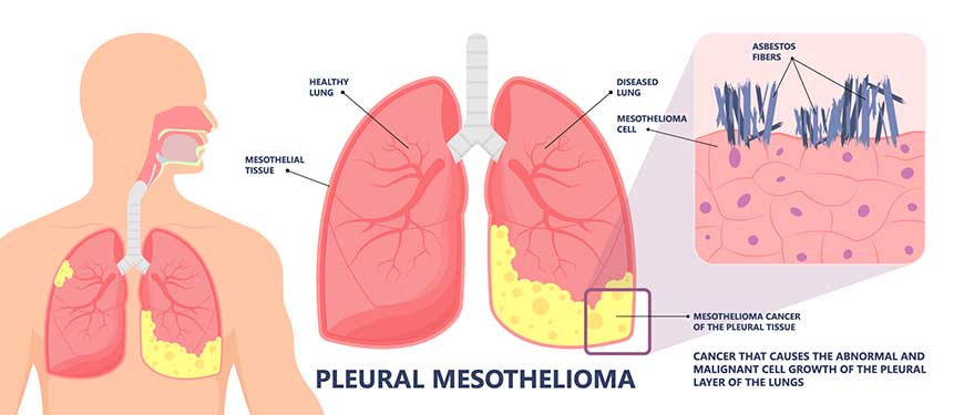 Pleural Mesothelioma