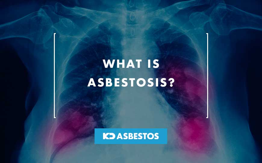What is Asbestosis